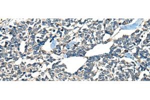Immunohistochemistry of paraffin-embedded Human lung cancer tissue using CDADC1 Polyclonal Antibody at dilution of 1:60(x200) (CDADC1 anticorps)