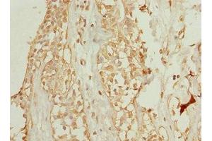 Immunohistochemistry of paraffin-embedded human breast cancer using ABIN7175750 at dilution of 1:100 (WDR38 anticorps  (AA 1-314))