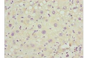 Immunohistochemistry of paraffin-embedded human liver cancer using ABIN7162977 at dilution of 1:100 (PEX14 anticorps  (AA 118-377))
