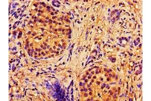 Immunohistochemistry of paraffin-embedded human pancreatic cancer using ABIN7144893 at dilution of 1:100 (ABCB7 anticorps  (AA 23-140))