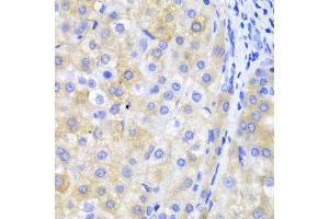 Immunohistochemistry of paraffin-embedded human liver cancer using FTH1 antibody at dilution of 1:100 (400x lens). (FTH1 anticorps)