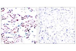 Immunohistochemical analysis of paraffin-embedded human breast carcinoma tissue using c-Jun (phospho-Thr91) antibody (E011021). (C-JUN anticorps  (pThr91))