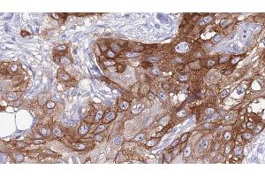 ABIN6273988 at 1/100 staining Human Head and neck cancer tissue by IHC-P. (RGR anticorps  (Internal Region))
