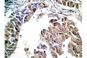 Human stomach cancer tissue was stained by rabbit Anti-Spexin prepro (36-58)  (H) Antibody (Spexin anticorps  (Preproprotein))