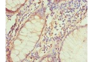 Immunohistochemistry of paraffin-embedded human colon cancer using ABIN7145332 at dilution of 1:100 (BNIP3L/NIX anticorps  (AA 1-187))