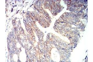 Immunohistochemical analysis of paraffin-embedded rectum cancer tissues using CD166 mouse mAb with DAB staining. (CD166 anticorps  (AA 227-381))