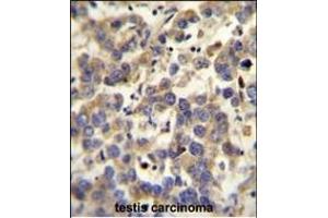 LYPD4 antibody (Center) (ABIN654302 and ABIN2844090) immunohistochemistry analysis in formalin fixed and paraffin embedded human testis carcinoma followed by peroxidase conjugation of the secondary antibody and DAB staining.