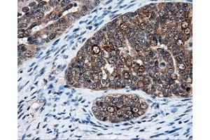 Immunohistochemical staining of paraffin-embedded Adenocarcinoma of breast tissue using anti-ELAVL1 mouse monoclonal antibody. (ELAVL1 anticorps)