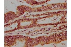 IHC image of ABIN7153701 diluted at 1:300 and staining in paraffin-embedded human colon cancer performed on a Leica BondTM system.