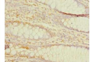 Immunohistochemistry of paraffin-embedded human colon cancer using ABIN7173249 at dilution of 1:100
