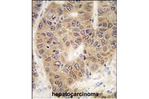 Formalin-fixed and paraffin-embedded human hepatocarcinoma tissue reacted with SUMO4 antibody (V55 Mutant) (ABIN388079 and ABIN2845841) , which was peroxidase-conjugated to the secondary antibody, followed by DAB staining.