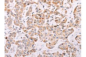 The image on the left is immunohistochemistry of paraffin-embedded Human breast cancer tissue using ABIN7189654(ADAMTS16 Antibody) at dilution 1/50, on the right is treated with synthetic peptide. (ADAMTS16 anticorps)