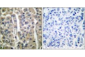 Immunohistochemistry analysis of paraffin-embedded human breast carcinoma tissue, using Involucrin Antibody. (Involucrin anticorps  (AA 536-585))