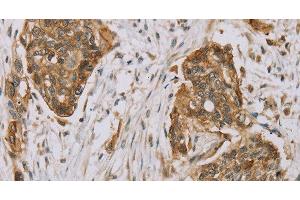 Immunohistochemistry of paraffin-embedded Human esophagus cancer using MVK Polyclonal Antibody at dilution of 1:40 (MVK anticorps)
