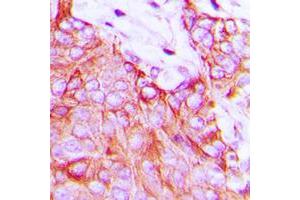 Immunohistochemical analysis of Ephrin A5 staining in human breast cancer formalin fixed paraffin embedded tissue section. (Ephrin A5 anticorps  (Center))