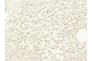 ABIN6263911 and ABIN6278220 at 1/100 staining human Hodgkin lymphoma by IHC-P.