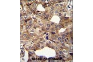 CCNI2 Antibody (Center) (ABIN655840 and ABIN2845254) immunohistochemistry analysis in formalin fixed and paraffin embedded human breast carcinoma followed by peroxidase conjugation of the secondary antibody and DAB staining. (CCNI2 anticorps  (AA 92-121))