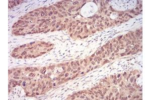 Immunohistochemical analysis of paraffin-embedded cervical cancer tissues using RAN mouse mAb with DAB staining.