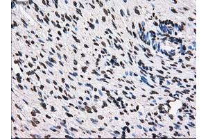 Immunohistochemical staining of paraffin-embedded Adenocarcinoma of breast tissue using anti-TTLL12 mouse monoclonal antibody. (TTLL12 anticorps)