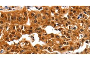 Immunohistochemistry of paraffin-embedded Human lung cancer using 14-3-3 beta/alpha Polyclonal Antibody at dilution of 1:30 (YWHAB anticorps)