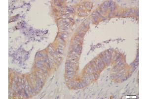 Formalin-fixed and paraffin embedded human cervical cancer labeled with Rabbit Anti-HSD17B1 Polyclonal Antibody, Unconjugated  at 1:200 followed by conjugation to the secondary antibody and DAB staining