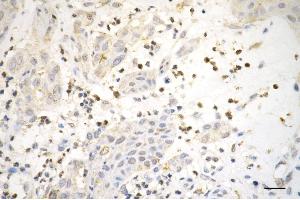 Immunohistochemistry was performed on paraffin-embedded human melanoma using phospho-cdk2 (Y15) antibody (ABIN7798209), 1:200).