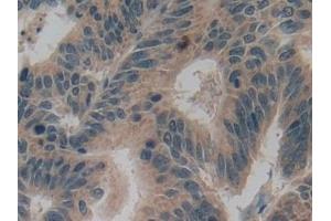 Detection of GAD2 in Human Colorectal cancer Tissue using Polyclonal Antibody to Glutamate Decarboxylase 2 (GAD2)