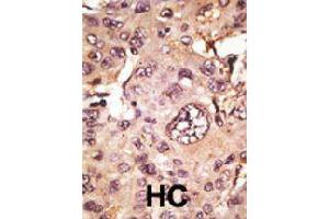 Formalin-fixed and paraffin-embedded human hepatocellular carcinoma tissue reacted with MAPT polyclonal antibody  , which was peroxidase-conjugated to the secondary antibody, followed by AEC staining. (MAPT anticorps  (C-Term))