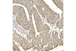 Immunohistochemistry of paraffin-embedded human colon carcinoma using GC1q R/C1QBP antibody (ABIN7266473) at dilution of 1:25 (40x lens).
