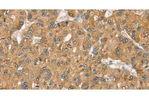 Immunohistochemistry of paraffin-embedded Human liver cancer using SEC14L2 Polyclonal Antibody at dilution of 1:40 (SEC14L2 anticorps)