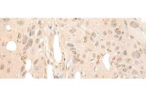 Immunohistochemistry of paraffin-embedded Human esophagus cancer tissue using DDX21 Polyclonal Antibody at dilution of 1:40(x200) (DDX21 anticorps)