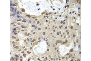 Immunohistochemistry of paraffin-embedded Human oophoroma using U2AF1 Polyclonal Antibody at dilution of 1:200 (40x lens). (U2AF1 anticorps)