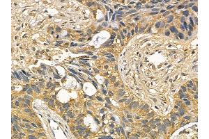 PIKFYVE Mouse Monoclonal Antibody at 1/100 staining human lung cancer and adjacent non-tumor tissue by IHC-P. (PIKFYVE anticorps)