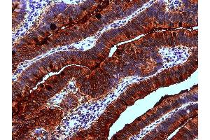 Immunohistochemistry staining of human colon adenocarcinoma (paraffin-embedded sections) with anti-Blood Group Lewis a (7LE). (Blood Group Lewis A anticorps)