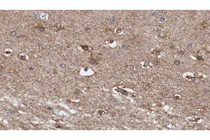 ABIN6278749 at 1/100 staining Human brain cancer tissue by IHC-P. (Acylglycerol Kinase anticorps  (C-Term))