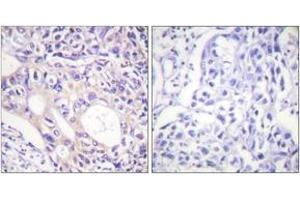 Immunohistochemistry analysis of paraffin-embedded human breast carcinoma, using Aurora Kinase (Phospho-Thr288) Antibody. (Aurora Kinase (AA 256-305), (pThr288) anticorps)