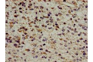 Immunohistochemistry of paraffin-embedded human glioma using ABIN7154609 at dilution of 1:100 (ERAL1 anticorps  (AA 271-382))