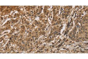 Immunohistochemistry of paraffin-embedded Human gastric cancer using CALU Polyclonal Antibody at dilution of 1:40 (CALU anticorps)