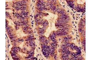 Immunohistochemistry analysis of human colon cancer using ABIN7151715 at dilution of 1:100