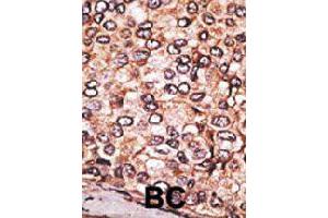 Formalin-fixed and paraffin-embedded human cancer tissue reacted with MAGEA2 polyclonal antibody  , which was peroxidase-conjugated to the secondary antibody, followed by AEC staining.