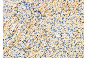 ABIN6259837 and ABIN6276791 at 1/100 staining Human ovarian cancer and adjacent normal tissues by IHC-P. (Fetuin A anticorps  (C-Term))