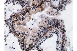 Immunohistochemical staining of paraffin-embedded Adenocarcinoma of Human breast tissue using anti-EPM2AIP1 mouse monoclonal antibody. (EPM2AIP1 anticorps)