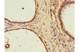 Immunohistochemistry of paraffin-embedded human prostate cancer using ABIN7169623 at dilution of 1:100 (SPPL2A anticorps  (AA 26-172))