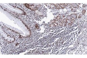 IHC-P Image Immunohistochemical analysis of paraffin-embedded human gastric cancer, using DDX39, antibody at 1:100 dilution. (BAT1 anticorps  (Center))