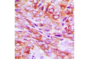 Immunohistochemical analysis of TMBIM1 staining in human breast cancer formalin fixed paraffin embedded tissue section.