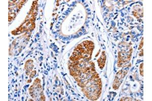 The image on the left is immunohistochemistry of paraffin-embedded Human stomach cancer tissue using ABIN7191274(LIF Antibody) at dilution 1/25, on the right is treated with synthetic peptide. (LIF anticorps)