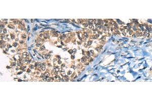 Immunohistochemistry of paraffin-embedded Human ovarian cancer tissue using CDKL4 Polyclonal Antibody at dilution of 1:45(x200) (CDKL4 anticorps)