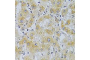 Immunohistochemistry of paraffin-embedded human liver cancer using EIF4G1 Antibody (ABIN5975844) at dilution of 1/100 (40x lens). (EIF4G1 anticorps)