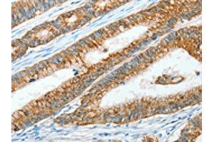 The image on the left is immunohistochemistry of paraffin-embedded Human colon cancer tissue using ABIN7128299(AGR3 Antibody) at dilution 1/15, on the right is treated with fusion protein. (AGR3 anticorps)