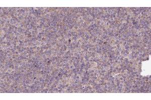 ABIN6273142 at 1/100 staining Human lymph cancer tissue by IHC-P. (Myosin XVIIIA anticorps  (Internal Region))